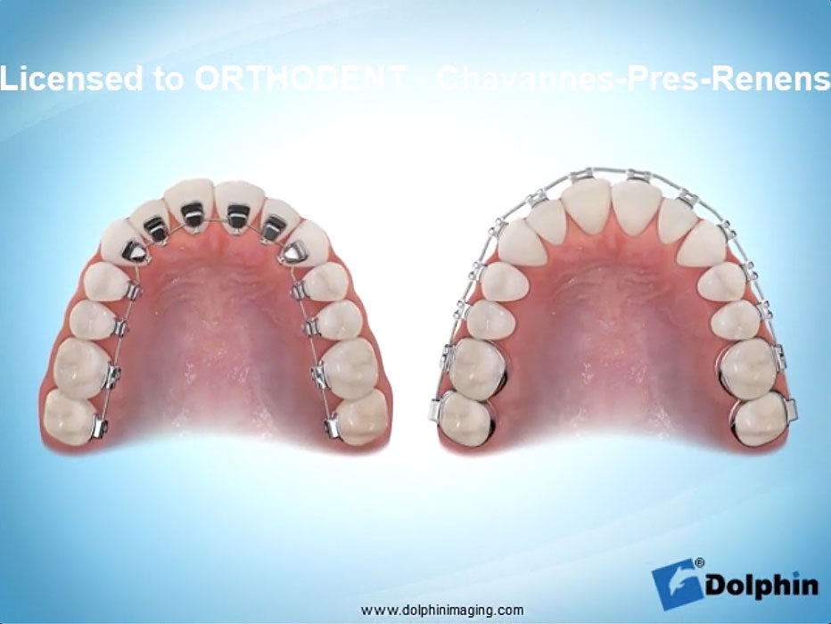 Orthodontie transparente Oberhausbergen - Gouttières invisibles